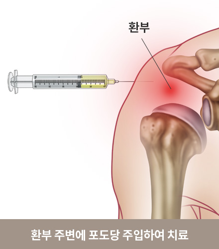 신경 프롤로 치료원리 이미지